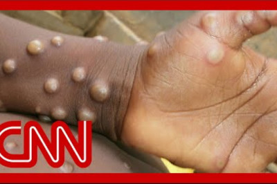Monkeypox - how does it spread and what are the symptoms?