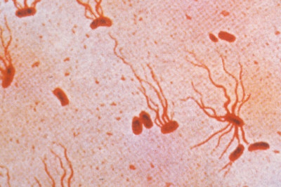 Antibiotic-resistant typhoid from Asia is spreading all over the world.